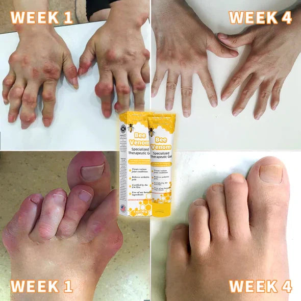 💎💎 AQA™ Bee Venom Joint Therapy Pain Relief Gel (New Zealand Bee Extract - Specializes in Orthopedic Diseases and Arthritis Pain)