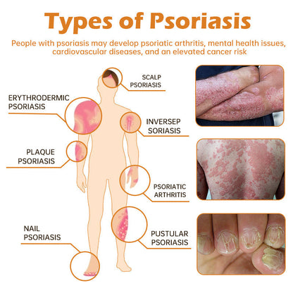 AQA™ PsoriaHeal Bee Venom Psoriasis Treatment Spray(Suitable for all skin conditions)