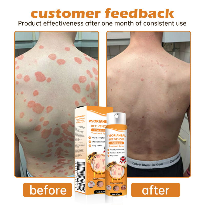 AQA™ PsoriaHeal Bee Venom Psoriasis Treatment Spray(Suitable for all skin conditions)