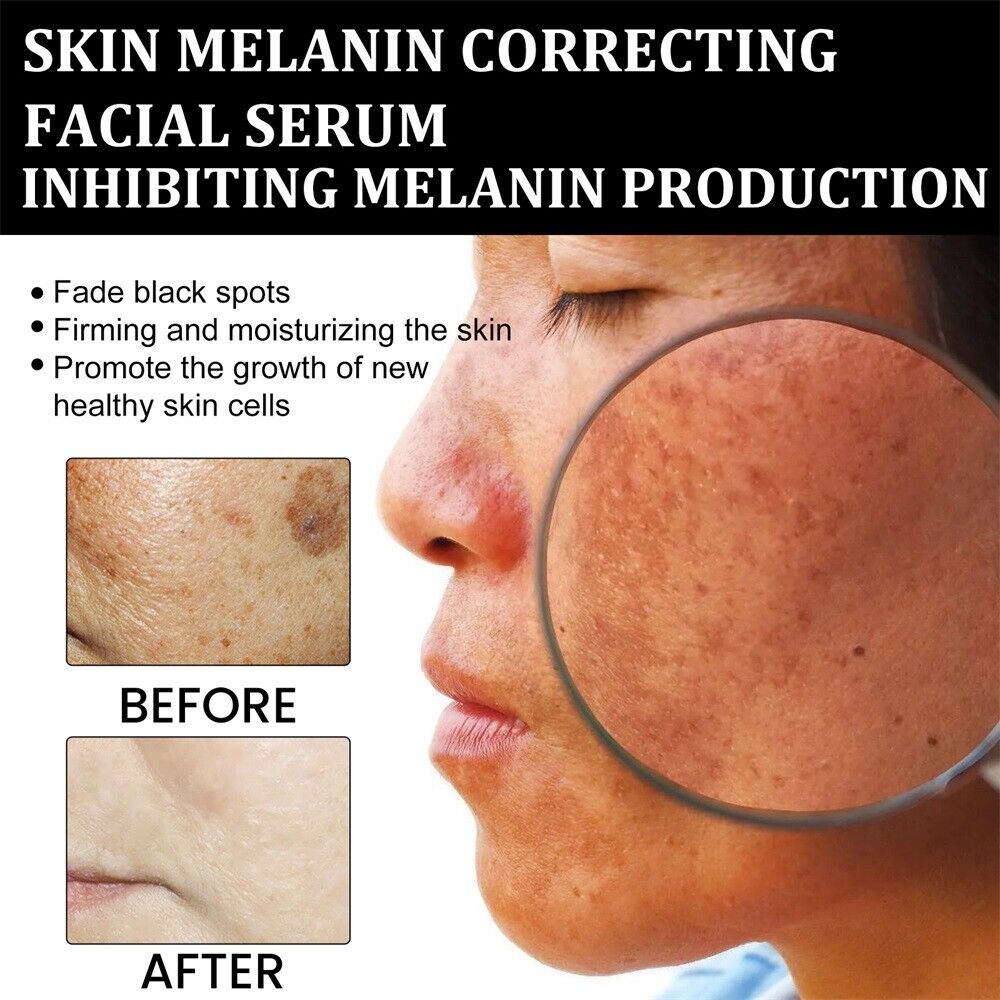 (Official Brand Store】 AQA™ Melanin Correcting Facial Serum-Tags & Moles & Dark Spot Remover