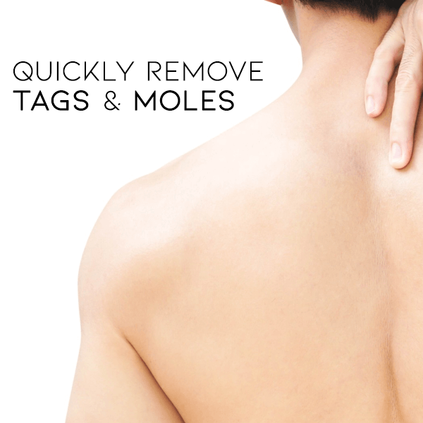 🔥🎁BUY 1 GET 1 FREE🎁 LOVILDS™ Tags & Moles Remover